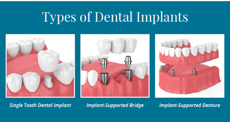 implants in dwarka