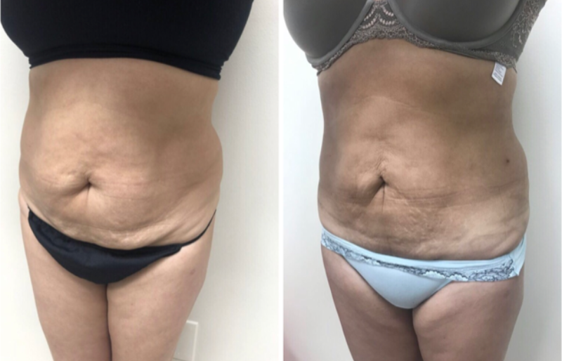 j plasma before and after