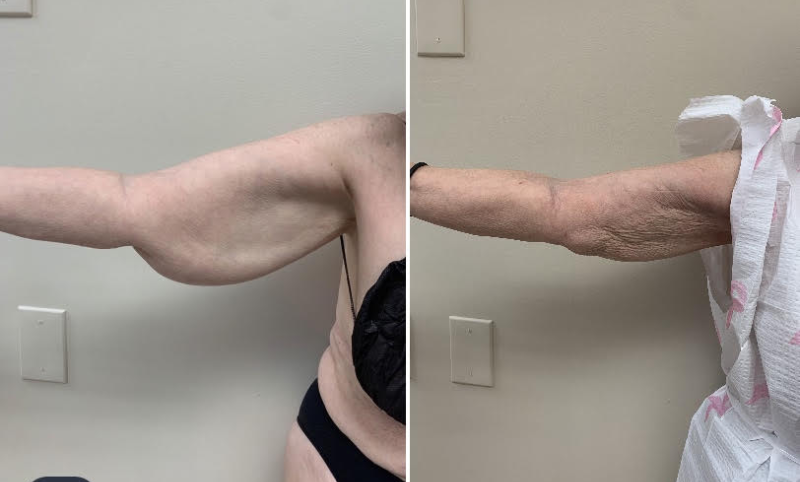 j plasma before and after