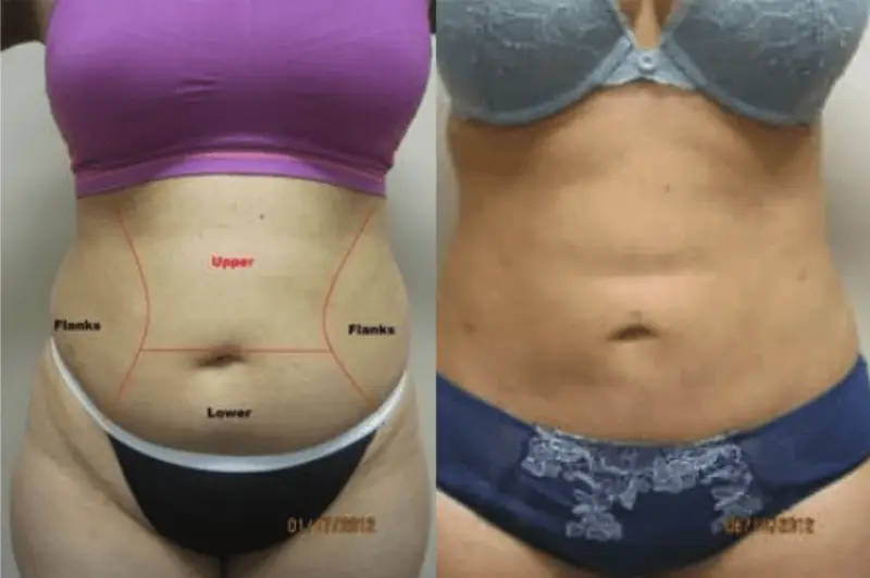 laser liposuction
