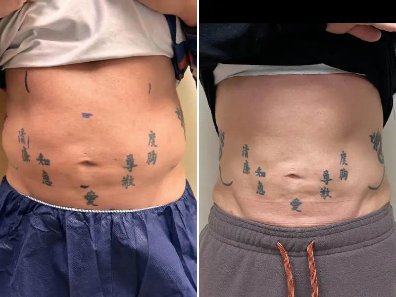 coolsculpting washington dc