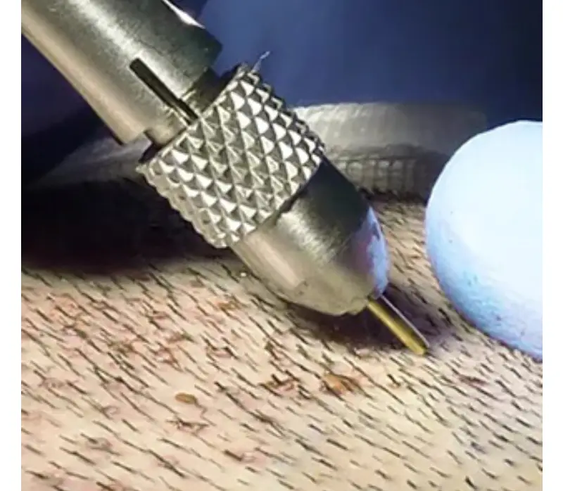 FUE hair transplant in Istanbul