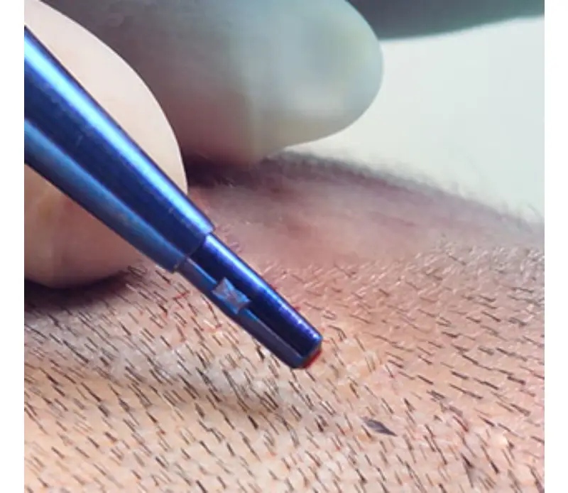FUE hair transplant in Istanbul
